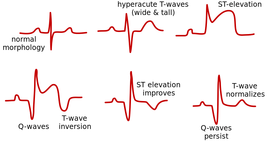 Monitor Like a Pro: Continuous ST segment&nbsp;monitoring
